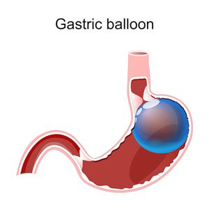 intragastric balloon diagram