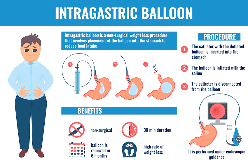 intragastric balloon infographic