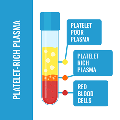 Illustration of platelet-rich plasma in a test tube, showing the three levels: red blood cells at the bottom, platelet-rich plasma, and platelet-poor plasma at the top