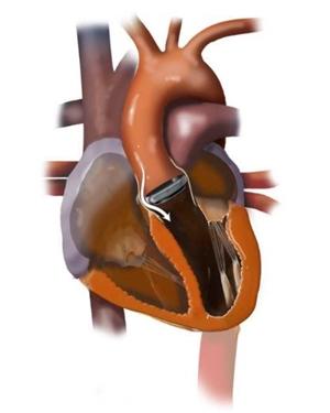 Illustration of a heart with a paravalvular leak