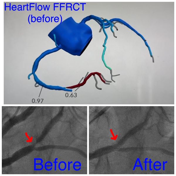 HeartFlow FFRCT