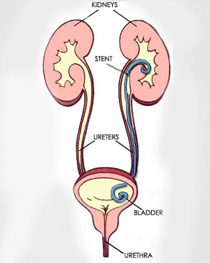 Illustration depicting a ureteral stent placed in the kidney and bladder